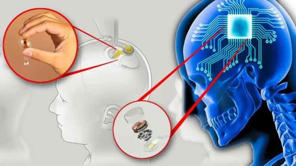 Neuralink, penanaman chip pada otak manusia