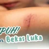 Cara Cepat Menghilangkan Bekas Luka