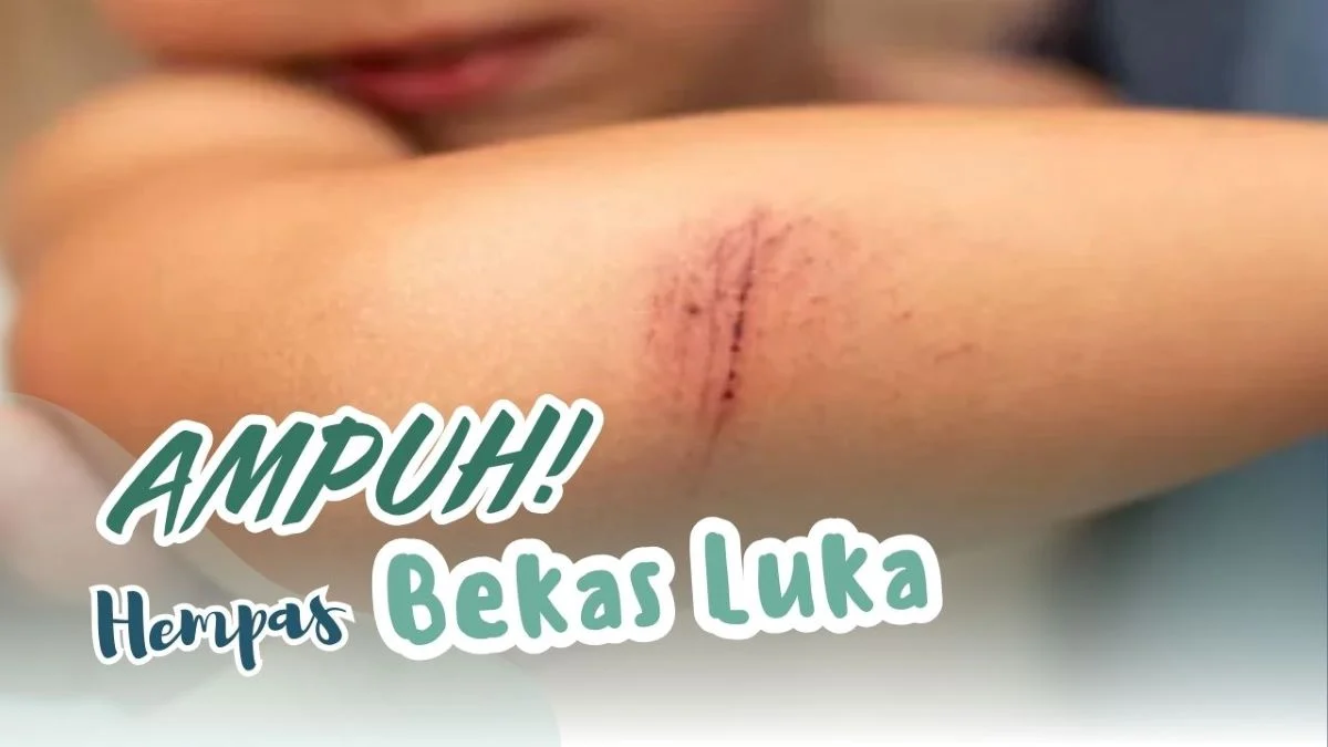 Cara Cepat Menghilangkan Bekas Luka