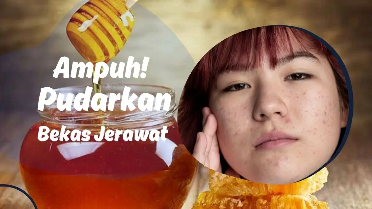 Bekas Jerawat