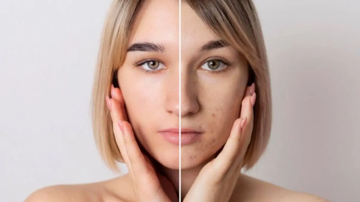 Skin Barrier Rusak
