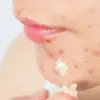 Obat Jerawat