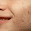 Cara Hilangkan Flek Hitam